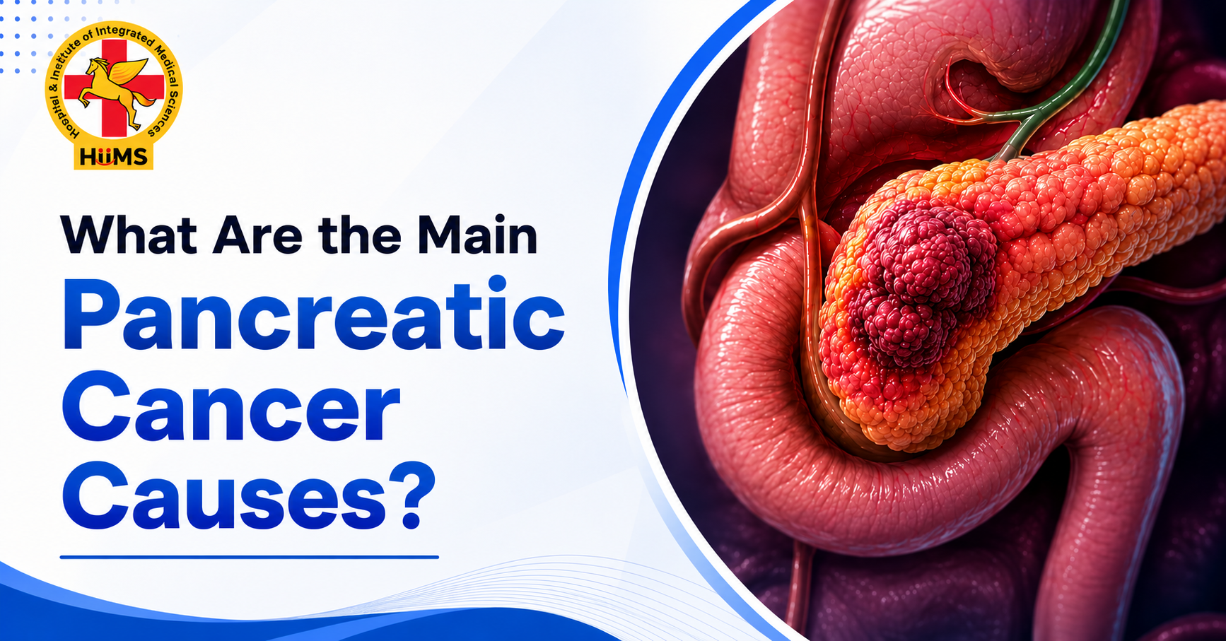 What Are the Main Pancreatic Cancer Causes? A Complete Guide